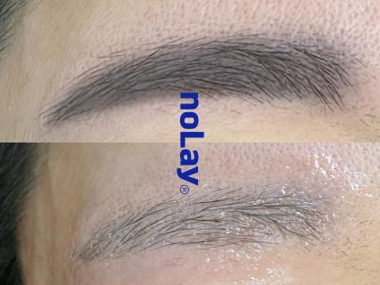 [송파구 방이역] 예쁘닷 잔흔제거