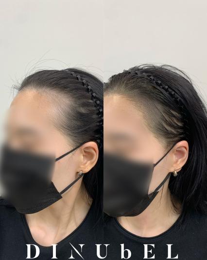 디뉴벨 눈썹&두피 대구본점